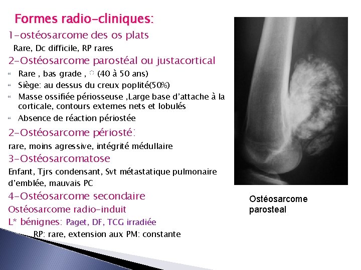 Formes radio-cliniques: 1 -ostéosarcome des os plats Rare, Dc difficile, RP rares 2 -Ostéosarcome