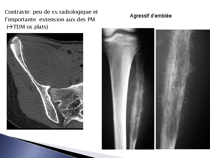 Contraste: peu de sx radiologique et l’importante extension aux des PM ( TDM os