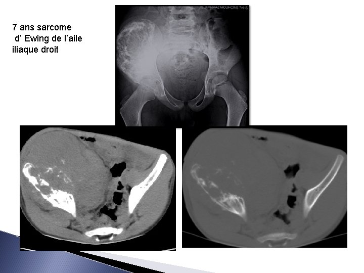 7 ans sarcome d’ Ewing de l’aile iliaque droit 