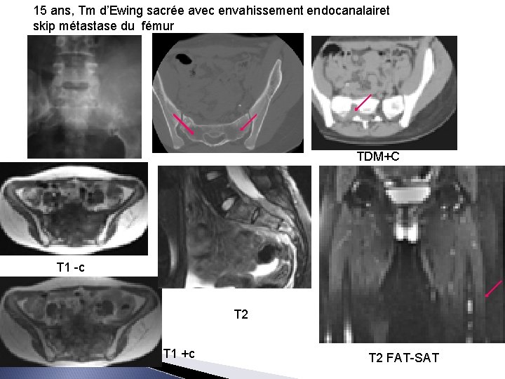 15 ans, Tm d’Ewing sacrée avec envahissement endocanalairet skip métastase du fémur TDM+C T