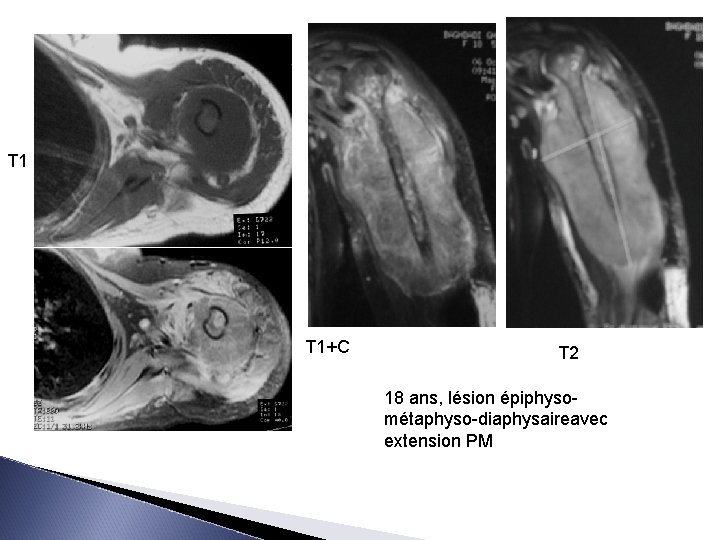 T 1 T 1+C T 2 18 ans, lésion épiphysométaphyso-diaphysaireavec extension PM 