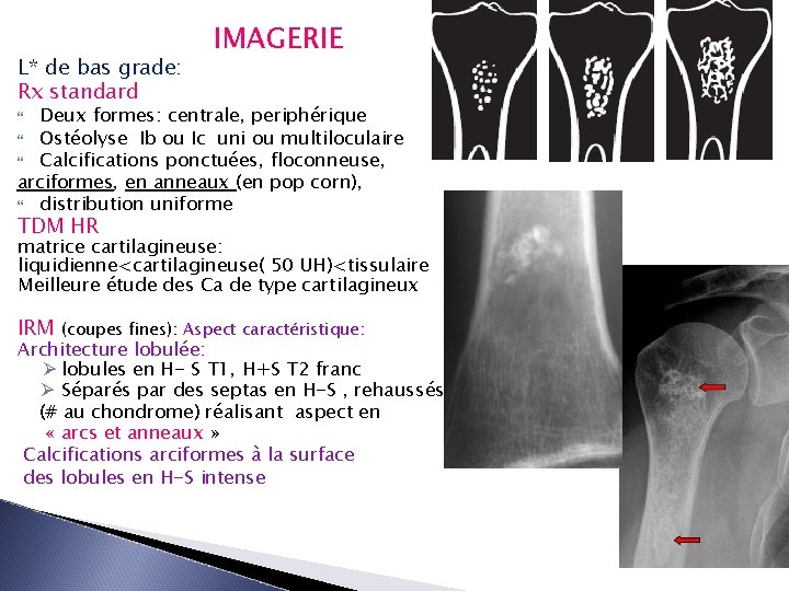 L* de bas grade: Rx standard IMAGERIE Deux formes: centrale, periphérique Ostéolyse Ib ou