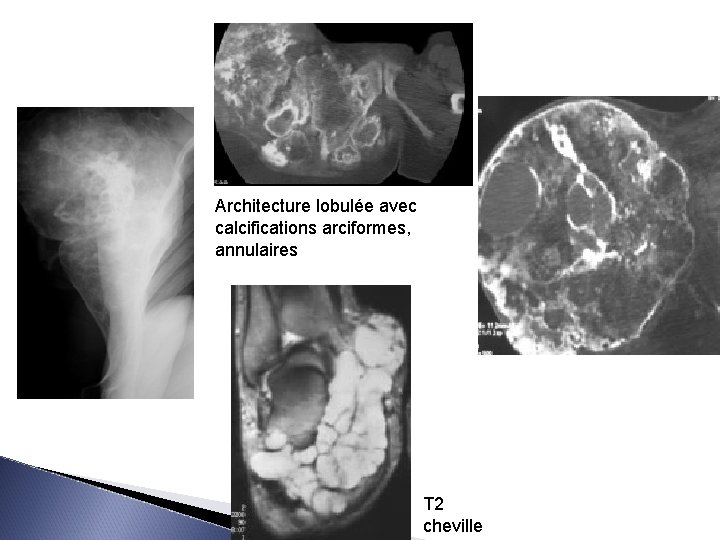 Architecture lobulée avec calcifications arciformes, annulaires T 2 cheville 