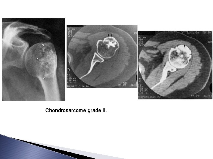 Chondrosarcome grade II. 