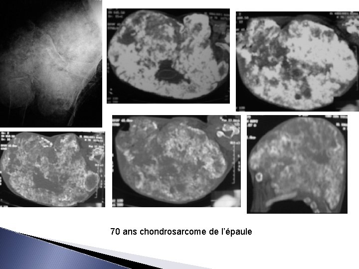 70 ans chondrosarcome de l’épaule 