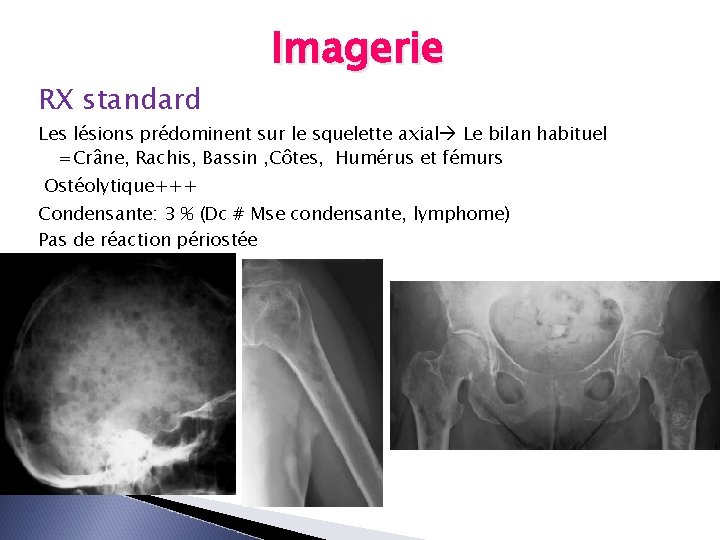 RX standard Imagerie Les lésions prédominent sur le squelette axial Le bilan habituel =Crâne,