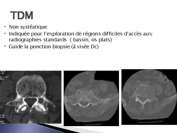 TDM Non systéatique Indiquée pour l’exploration de régions difficiles d’accès aux radiographies standards (