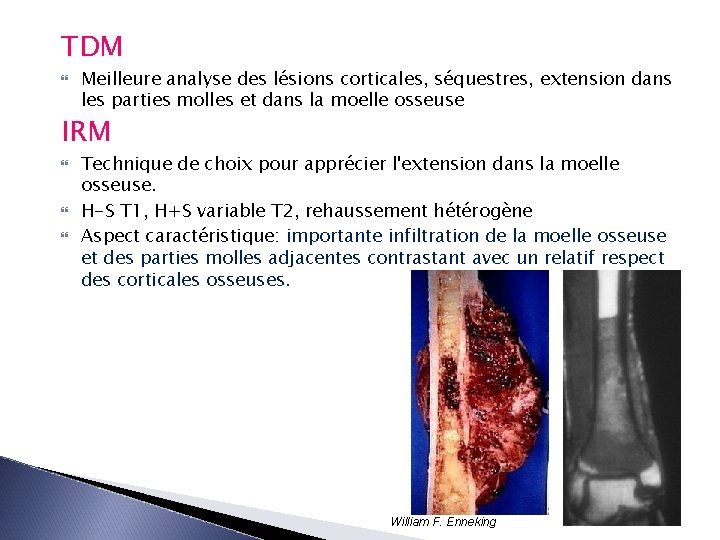 TDM Meilleure analyse des lésions corticales, séquestres, extension dans les parties molles et dans