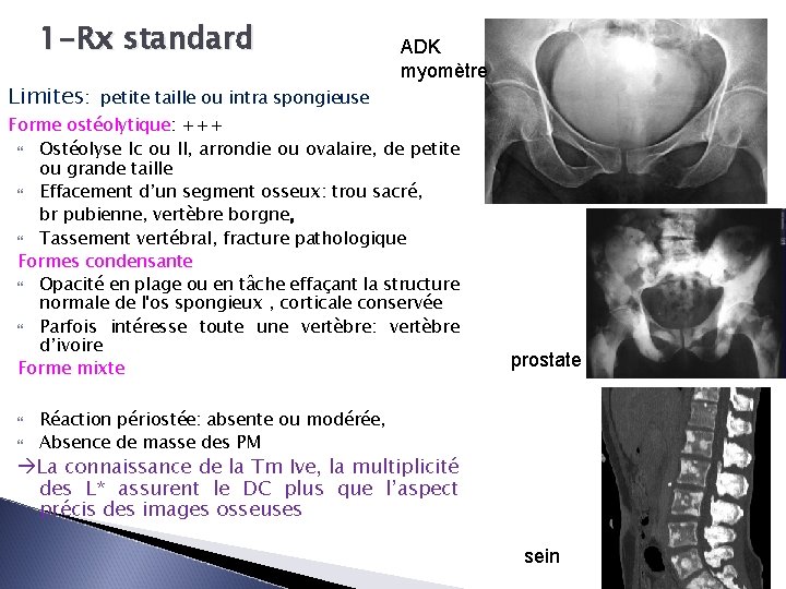 1 -Rx standard Limites: ADK myomètre petite taille ou intra spongieuse Forme ostéolytique: +++