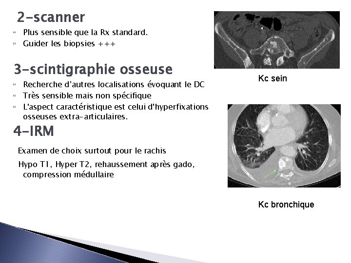 2 -scanner Plus sensible que la Rx standard. Guider les biopsies +++ 3 -scintigraphie