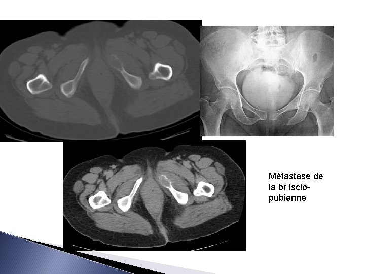 Métastase de la br isciopubienne 