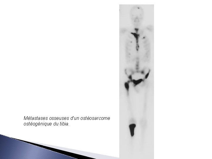 Métastases osseuses d’un ostéosarcome ostéogénique du tibia. 