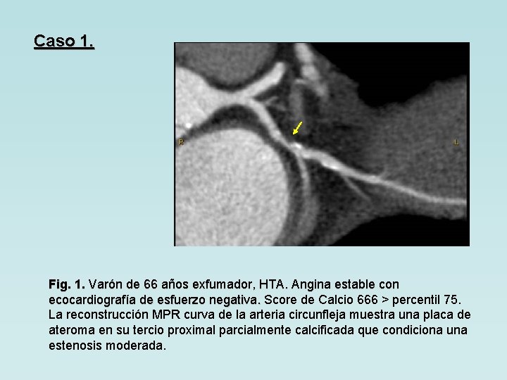 Caso 1. Fig. 1. Varón de 66 años exfumador, HTA. Angina estable con ecocardiografía