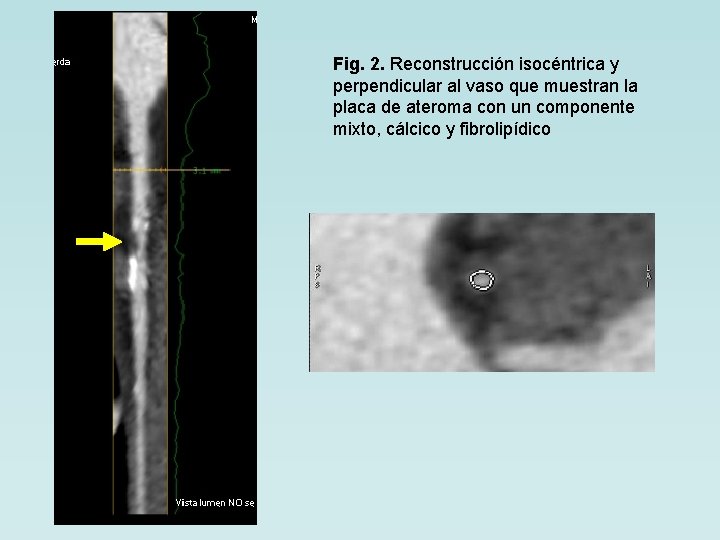 Fig. 2. Reconstrucción isocéntrica y perpendicular al vaso que muestran la placa de ateroma