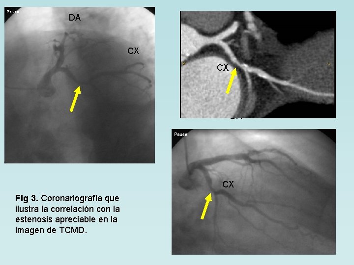 DA CX CX DA CX Fig 3. Coronariografía que ilustra la correlación con la