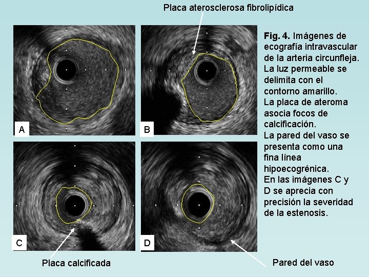 Placa aterosclerosa fibrolipídica A B C D Placa calcificada Fig. 4. Imágenes de ecografía