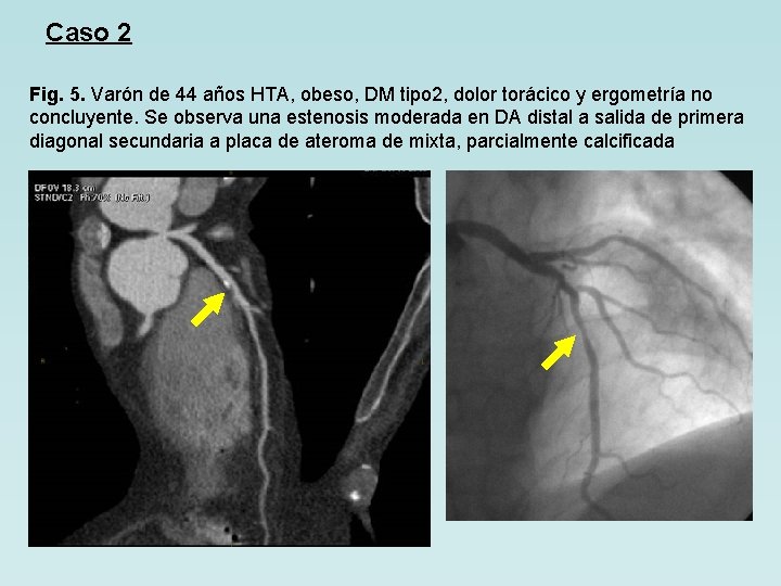 Caso 2 Fig. 5. Varón de 44 años HTA, obeso, DM tipo 2, dolor