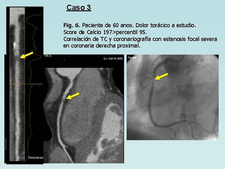 Caso 3 Fig. 6. Paciente de 60 anos. Dolor torácico a estudio. Score de