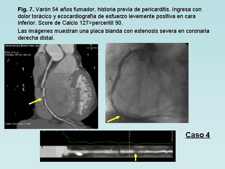 Fig. 7. Varón 54 años fumador, historia previa de pericarditis. Ingresa con dolor torácico
