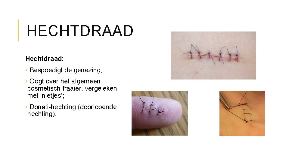 HECHTDRAAD Hechtdraad: • Bespoedigt de genezing; • Oogt over het algemeen cosmetisch fraaier, vergeleken