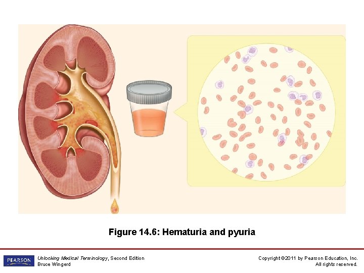 Figure 14. 6: Hematuria and pyuria Unlocking Medical Terminology, Second Edition Bruce Wingerd Copyright