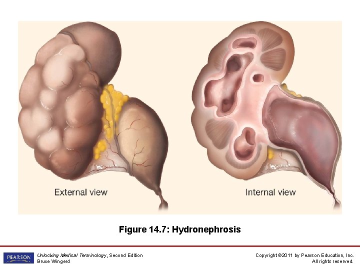 Figure 14. 7: Hydronephrosis Unlocking Medical Terminology, Second Edition Bruce Wingerd Copyright © 2011