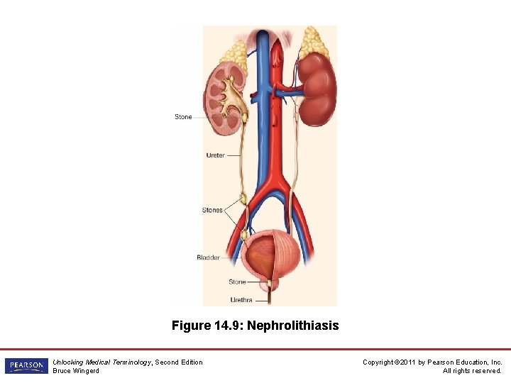 Figure 14. 9: Nephrolithiasis Unlocking Medical Terminology, Second Edition Bruce Wingerd Copyright © 2011