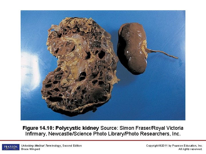 Figure 14. 10: Polycystic kidney Source: Simon Fraser/Royal Victoria Infirmary, Newcastle/Science Photo Library/Photo Researchers,