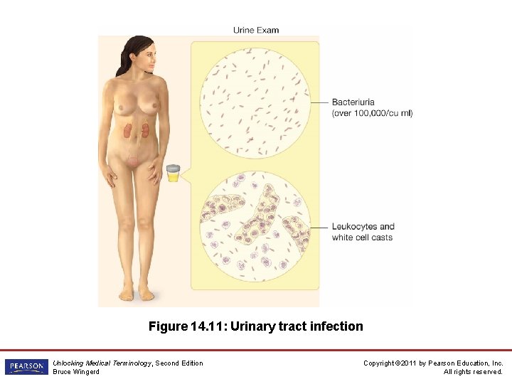 Figure 14. 11: Urinary tract infection Unlocking Medical Terminology, Second Edition Bruce Wingerd Copyright