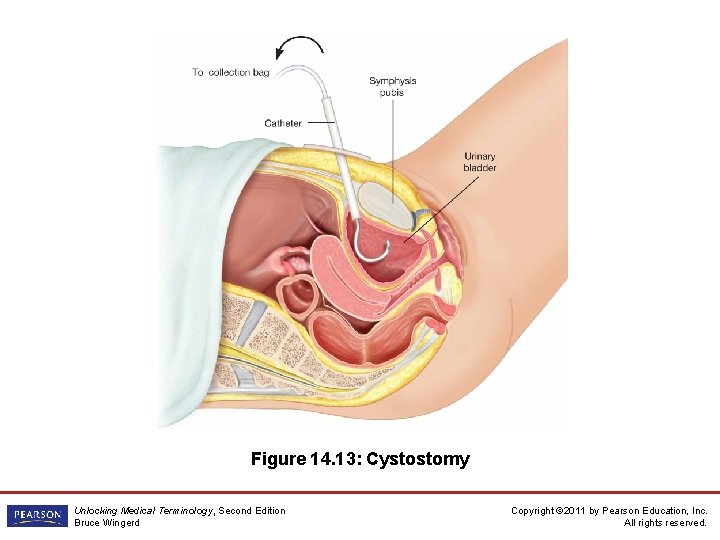 Figure 14. 13: Cystostomy Unlocking Medical Terminology, Second Edition Bruce Wingerd Copyright © 2011