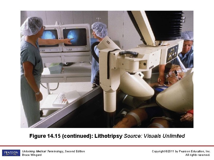 Figure 14. 15 (continued): Lithotripsy Source: Visuals Unlimited Unlocking Medical Terminology, Second Edition Bruce