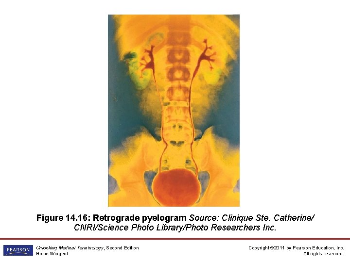 Figure 14. 16: Retrograde pyelogram Source: Clinique Ste. Catherine/ CNRI/Science Photo Library/Photo Researchers Inc.