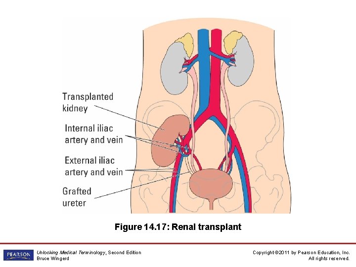 Figure 14. 17: Renal transplant Unlocking Medical Terminology, Second Edition Bruce Wingerd Copyright ©