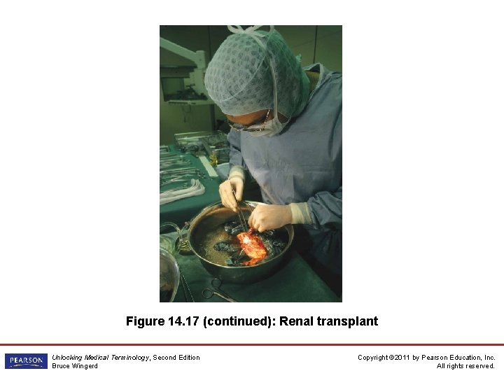 Figure 14. 17 (continued): Renal transplant Unlocking Medical Terminology, Second Edition Bruce Wingerd Copyright