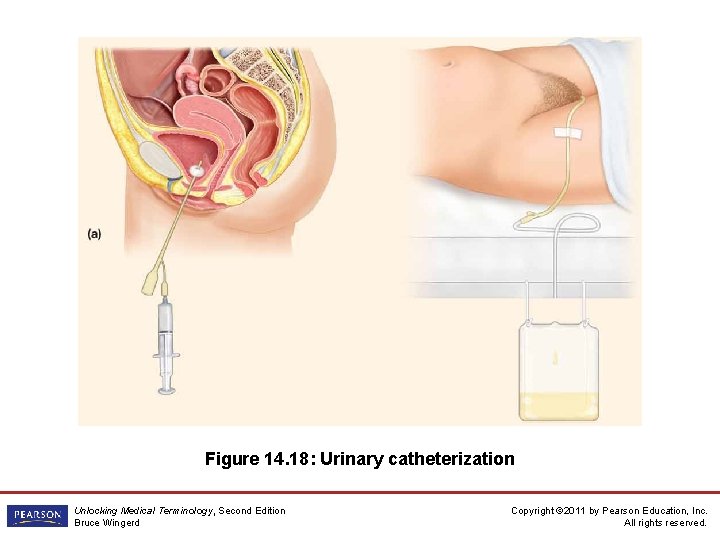 Figure 14. 18: Urinary catheterization Unlocking Medical Terminology, Second Edition Bruce Wingerd Copyright ©