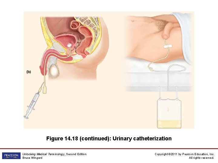 Figure 14. 18 (continued): Urinary catheterization Unlocking Medical Terminology, Second Edition Bruce Wingerd Copyright