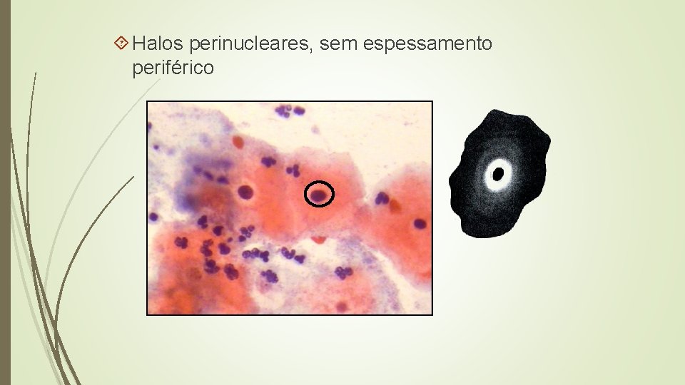  Halos perinucleares, sem espessamento periférico 