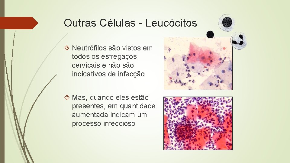 Outras Células - Leucócitos Neutrófilos são vistos em todos os esfregaços cervicais e não