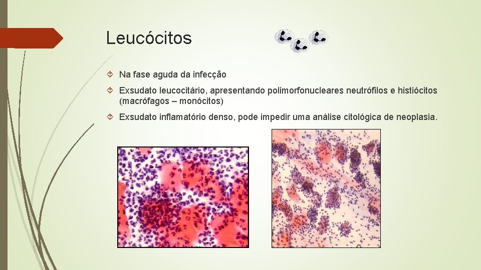 Leucócitos Na fase aguda da infecção Exsudato leucocitário, apresentando polimorfonucleares neutrófilos e histiócitos (macrófagos