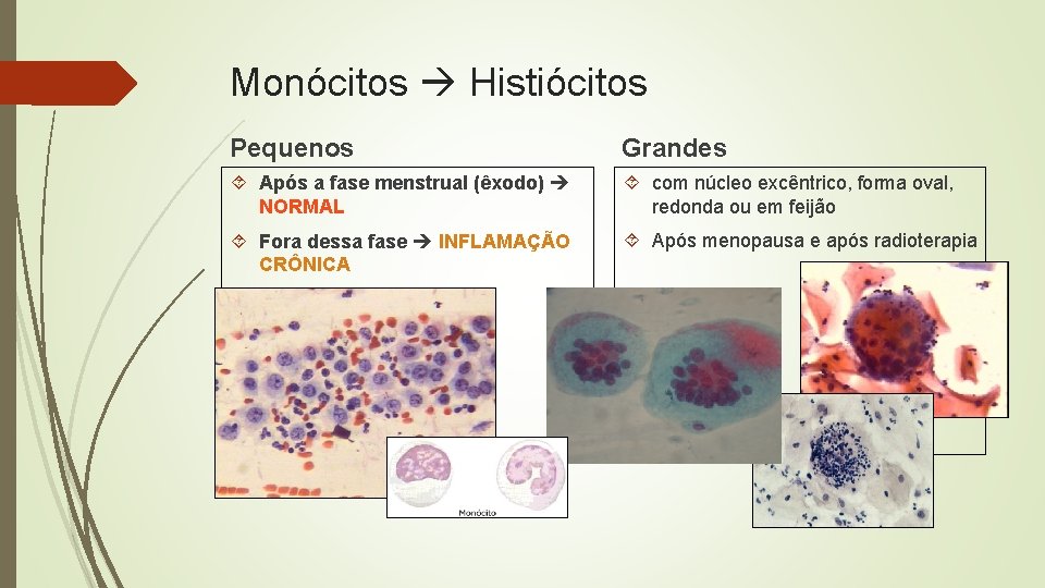 Monócitos Histiócitos Pequenos Grandes Após a fase menstrual (êxodo) NORMAL com núcleo excêntrico, forma