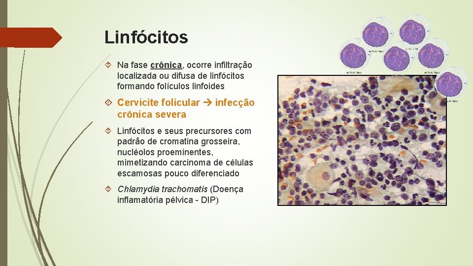 Linfócitos Na fase crônica, ocorre infiltração localizada ou difusa de linfócitos formando folículos linfoides