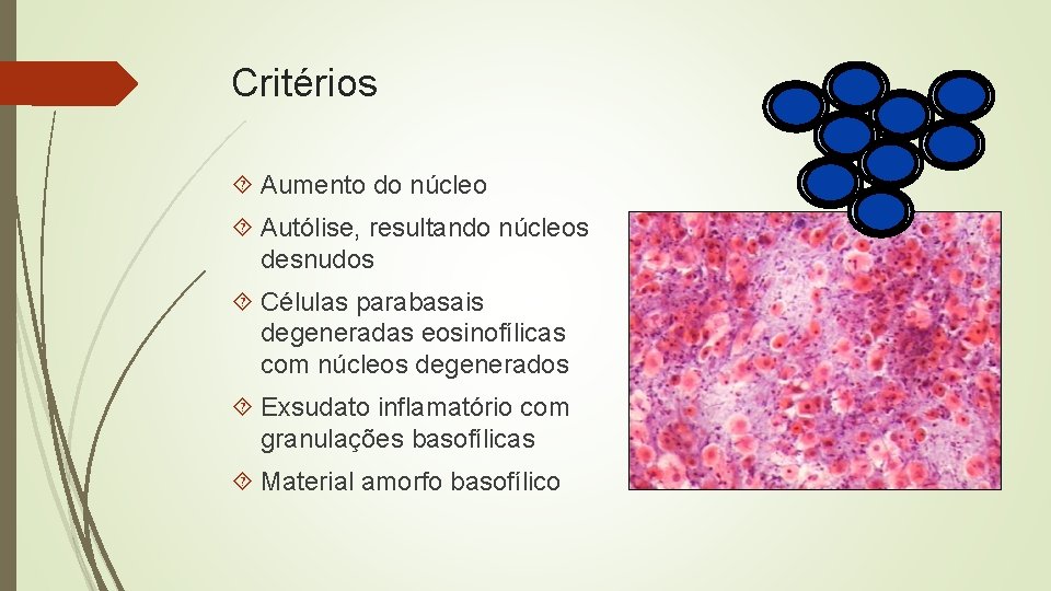 Critérios Aumento do núcleo Autólise, resultando núcleos desnudos Células parabasais degeneradas eosinofílicas com núcleos