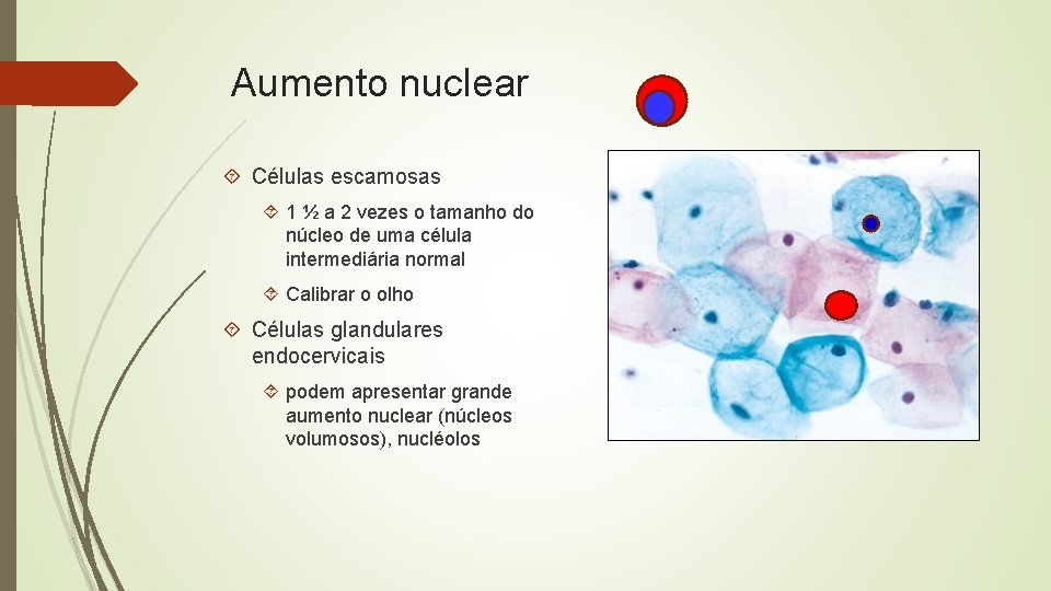 Aumento nuclear Células escamosas 1 ½ a 2 vezes o tamanho do núcleo de