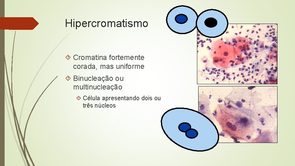 Hipercromatismo Cromatina fortemente corada, mas uniforme Binucleação ou multinucleação Célula apresentando dois ou três