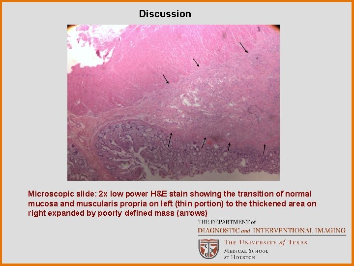 Discussion Microscopic slide: 2 x low power H&E stain showing the transition of normal