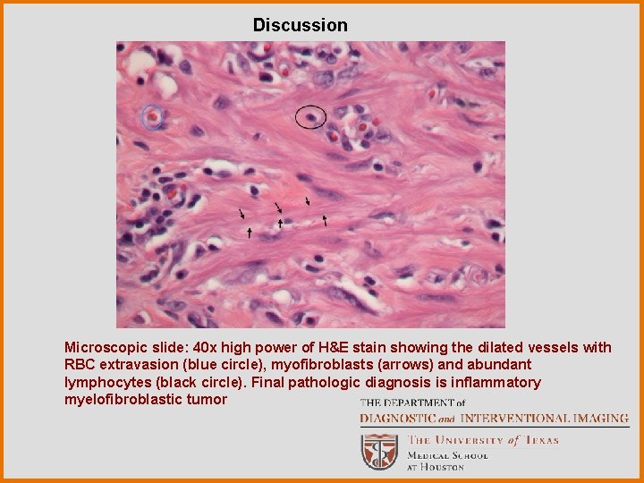 Discussion Microscopic slide: 40 x high power of H&E stain showing the dilated vessels