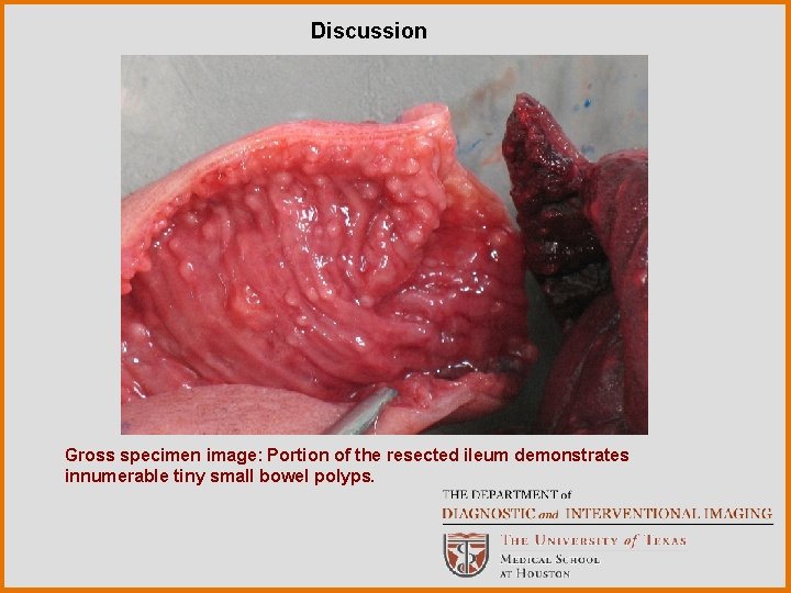 Discussion Gross specimen image: Portion of the resected ileum demonstrates innumerable tiny small bowel