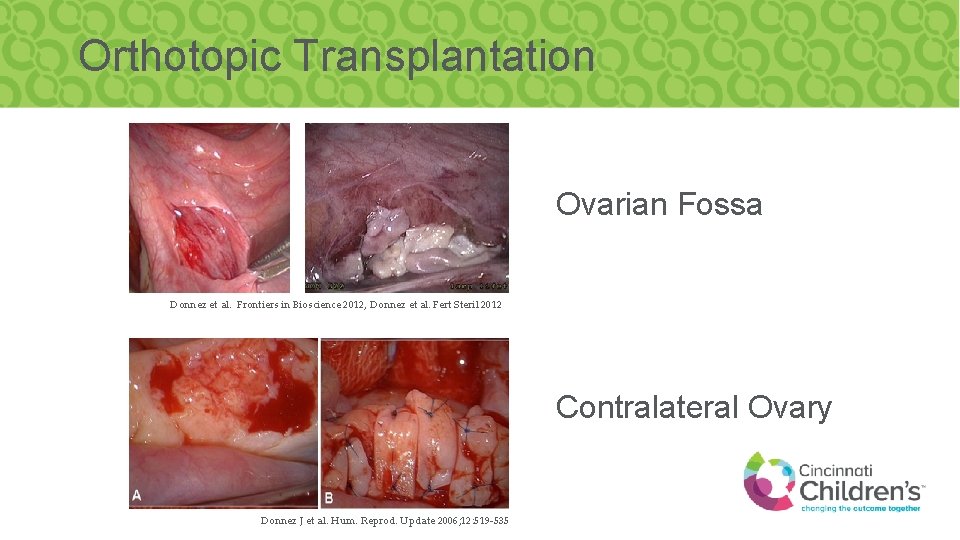 Orthotopic Transplantation Ovarian Fossa Donnez et al. Frontiers in Bioscience 2012, Donnez et al.