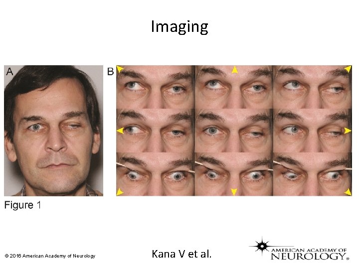 Imaging © 2016 American Academy of Neurology Kana V et al. 