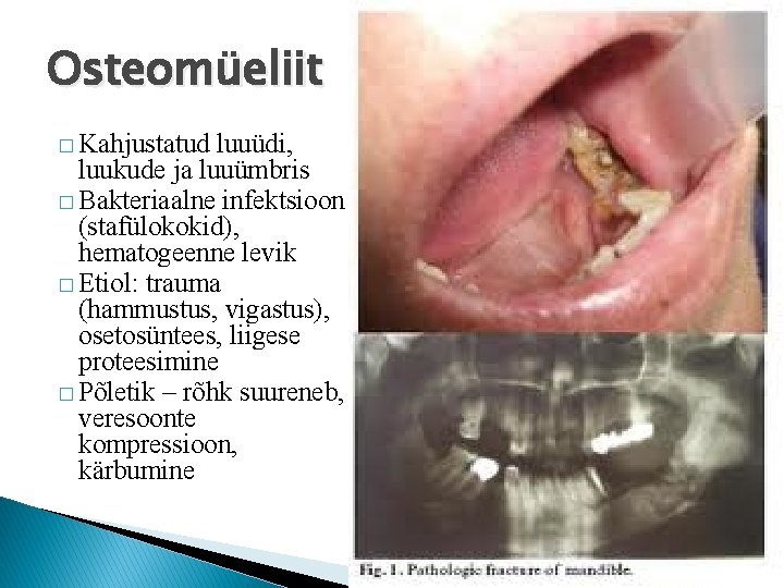 Osteomüeliit � Kahjustatud luuüdi, luukude ja luuümbris � Bakteriaalne infektsioon (stafülokokid), hematogeenne levik �